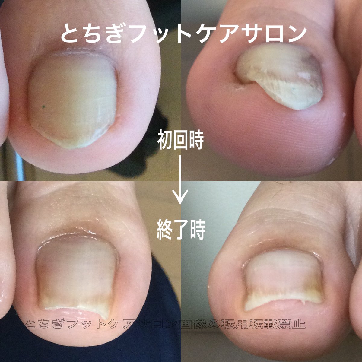 とちぎフットケアサロン-茂木有紀 (@fuss04tochigi) / Posts / X