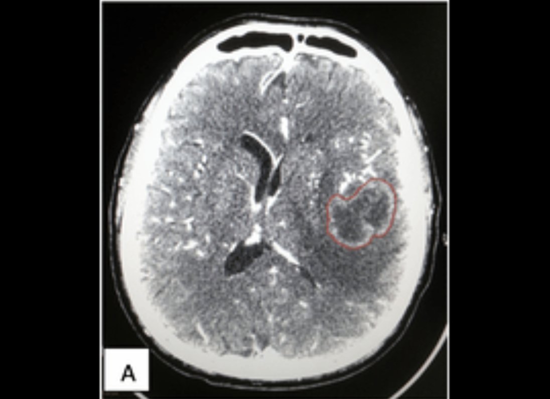 Images_Case's tweet photo. Quantitative CT Volumetric Measurement of Peritumoral Edema Assists in Differentiate Between Primary Brain Tumor and Solitary Metastatic Brain Tumor: Brain imaging is necessary in clarifying intracranial pathology that produces clinical symptoms...
https://t.co/sevrIhLVnl https://t.co/P0bC5McgaC