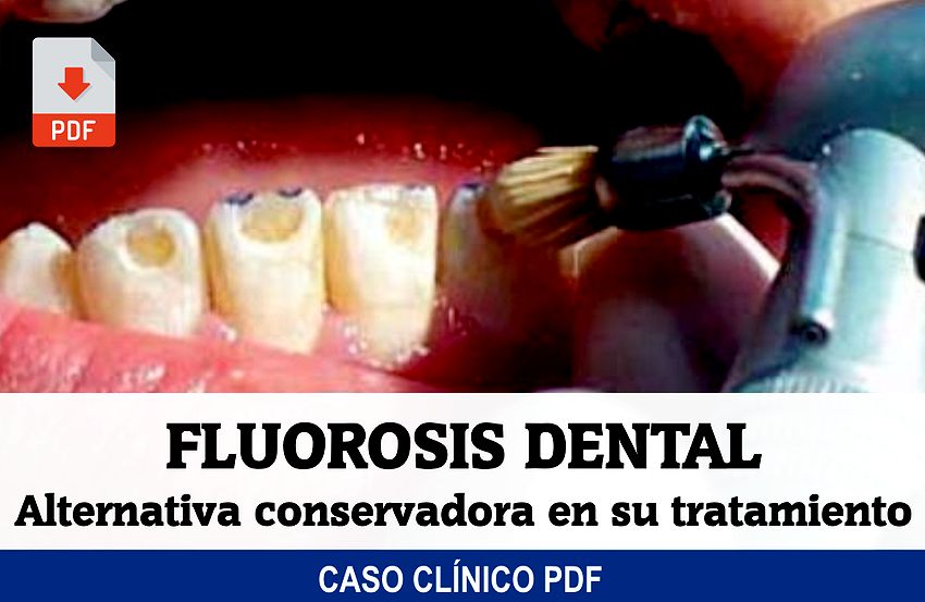 PDF biodentista.com/2020/09/pdf-fl…

Actualmente se puede elegir entre diversas técnicas clínicas, sin embargo, la correcta selección del tratamiento depende principalmente de una adecuada valoración de la severidad de la patología.

Se describe un caso clínico de un paciente con
