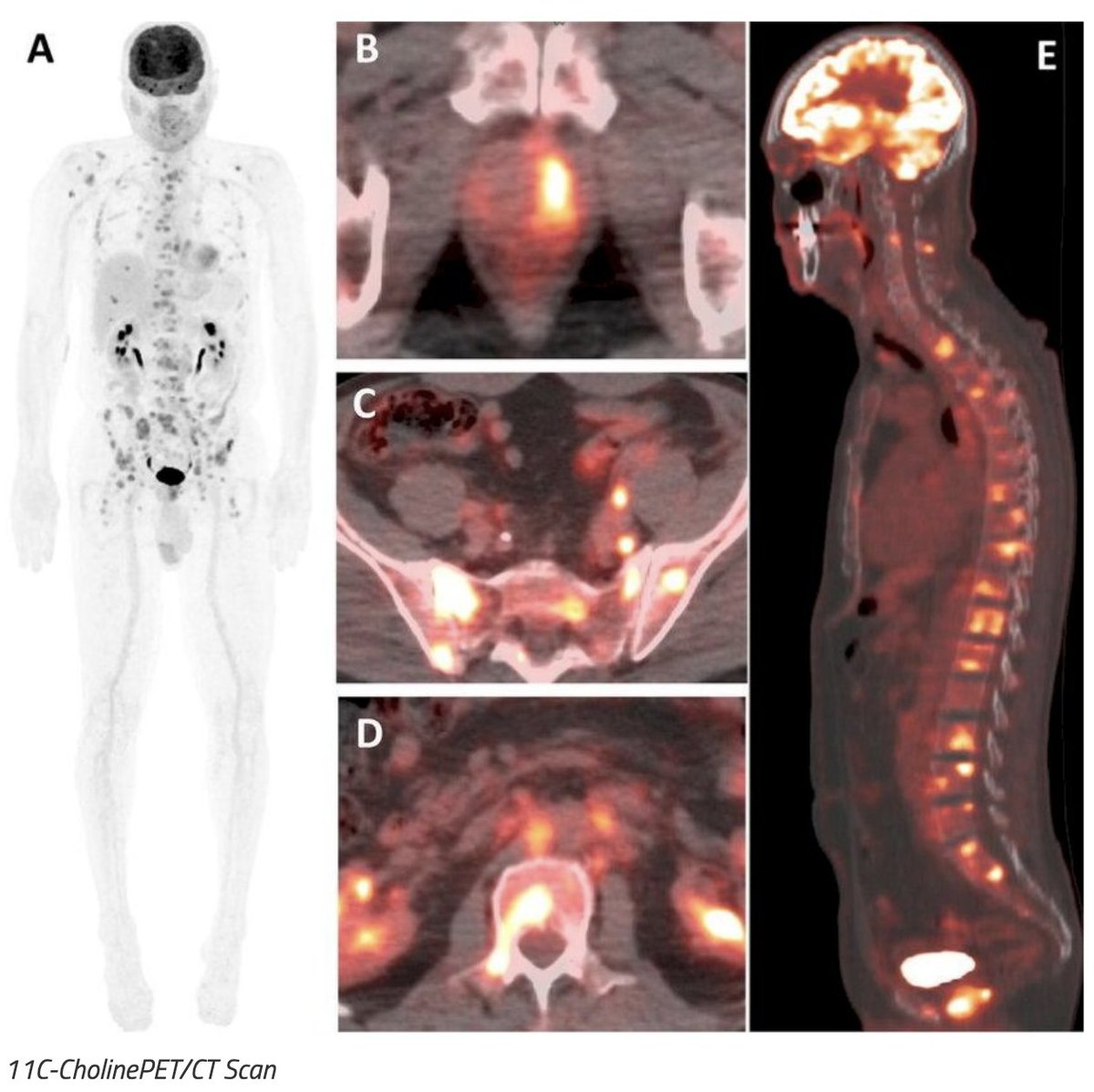 UroToday.com (@urotoday) on Twitter photo Interdisciplinary #GUCancerForum 2025: Impact of molecular targeted imaging on nonmetastatic castration resistant #ProstateCancer. Presentation by Shereif Gamie, MD, PhD <a href="/UCSanDiego/">UC San Diego</a>. Written coverage by <a href="/chavarriagaj/">Julian Chavarriaga</a> <a href="/UofT/">University of Toronto</a> > bit.ly/3HP7i8k Interdisciplinary #GUCancerForum 2025: Impact of molecular targeted imaging on nonmetastatic castration resistant #ProstateCancer. Presentation by Shereif Gamie, MD, PhD <a href="/UCSanDiego/">UC San Diego</a>. Written coverage by <a href="/chavarriagaj/">Julian Chavarriaga</a> <a href="/UofT/">University of Toronto</a> > bit.ly/3HP7i8k