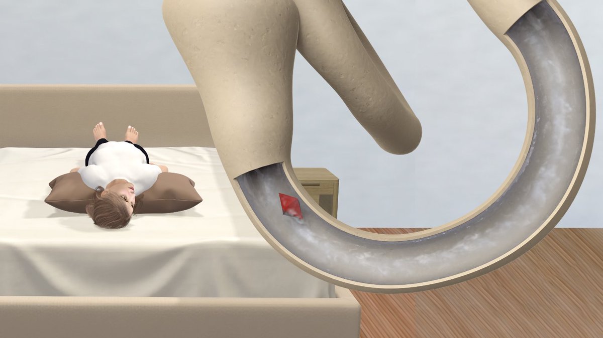 Epley Maneuver to Treat BPPV Dizziness youtu.be/gCVb23c_d2M