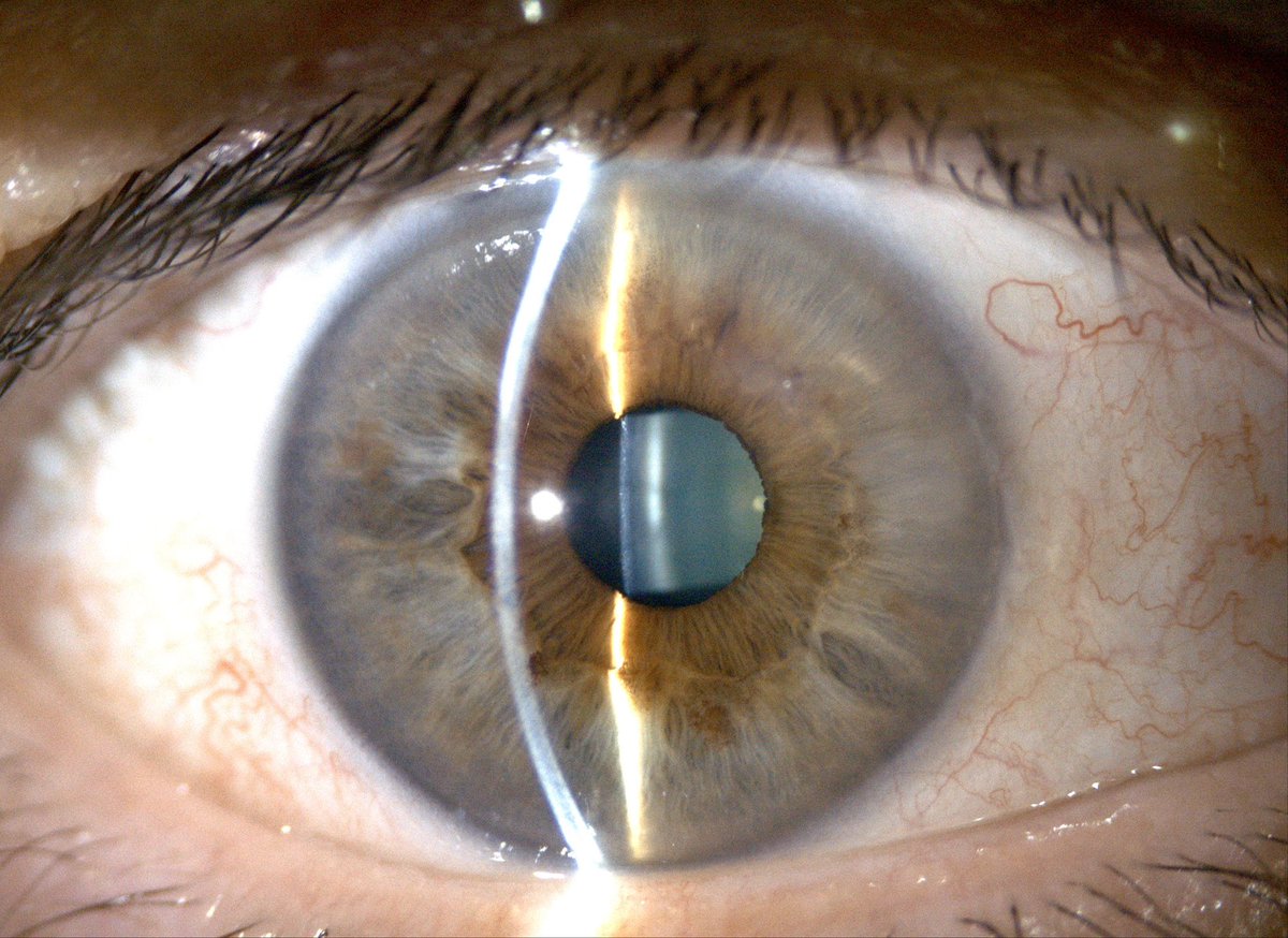 Tweet Atlas of Optical Phenomena (155)

My eye… a close view 😉👁️

Image recorded with a unique automatic lightfield slit-lamp device 

<a href="/OpticaWorldwide/">Optica</a>
<a href="/sedoptica/">SEDOPTICA</a>
<a href="/SPIEtweets/">SPIE</a>
<a href="/europeanoptics/">European Optical Society (EOS)</a>
<a href="/ESCRSofficial/">ESCRS</a>
<a href="/ARVOinfo/">ARVO</a>