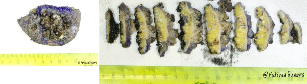 📣📣📣 Lymphangioma circumscriptum
 
•A benign lymphatic malformation involving superficial and deep dermal lymphatic channels.

•Clinical Appearance: Clusters of clear or pink vesicles resembling “frog spawn”; may ooze lymphatic fluid. Can be asymptomatic or associated with