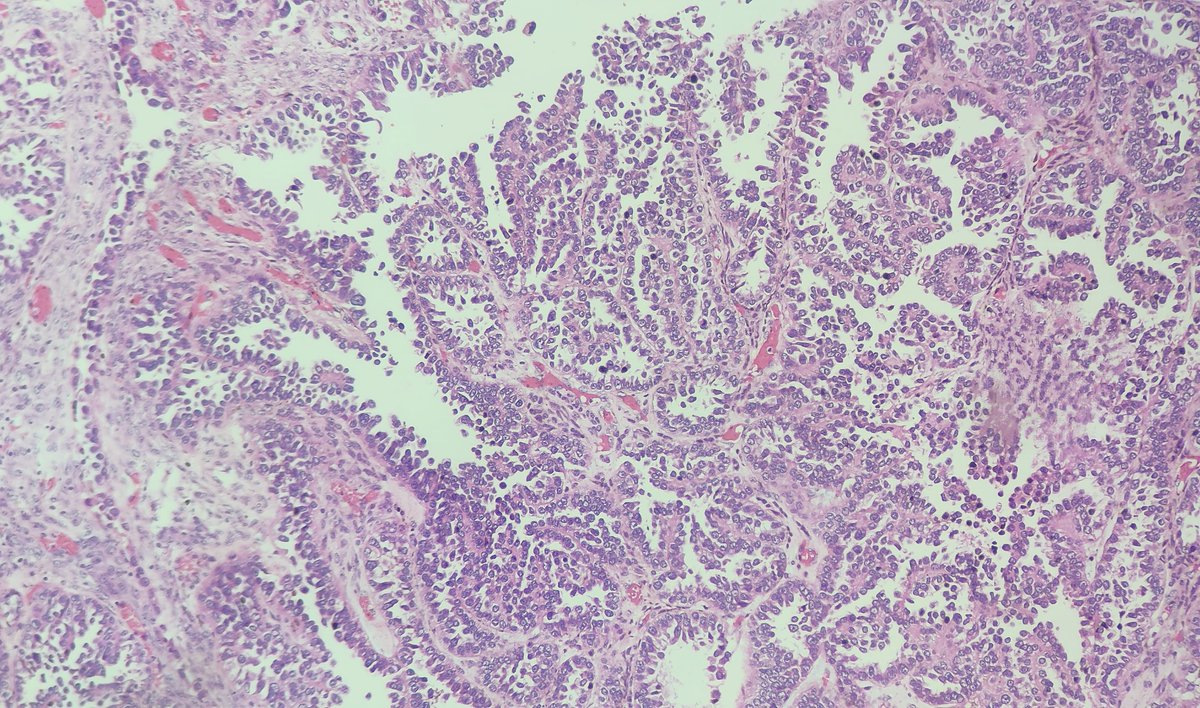 #pathclassic 
#pathresidents
#PathTwitter 
#gynpath

Cystic mass in the ovary
Cuboidal to hobnail cells
Tubular and papillary pattern

Clear cell carcinoma of the ovary

Case courtesy - Dr Saraswathi Ram Mohan <a href="/saraswathi_rm/">saraswathi</a>