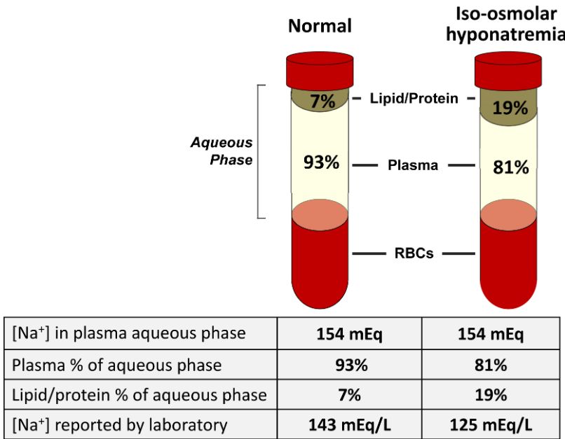 #Quiz: A 77-yr-old man was admitted for chemo for multiple myeloma. His kidney function was worsening. He had elevated gamma fraction and high IgG κ light chain levels. A peripheral smear showed over 20% plasma cells. 

What is the diagnosis?

bit.ly/34hZ6JU (FREE)