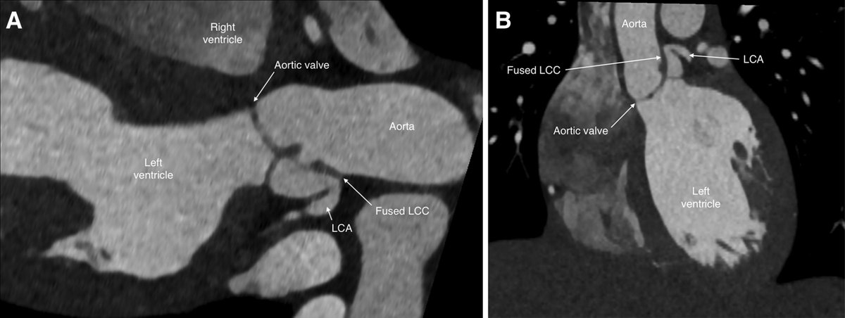 European Society of Cardiology Journals (@esc_journals) on Twitter photo Left coronary ostial isolation in a young boy caused by a dysplastic aortic valve: a case report. ow.ly/PUOc50W5iJH
#EHJCaseReports <a href="/Phiso_de/">Philipp Sommer</a> <a href="/TJ_Yeo/">Tee Joo YEO</a> <a href="/aayshacader/">Aaysha Cader</a> <a href="/BoldiKovacsMD/">Boldizsar Kovacs</a> <a href="/KardiologieHH/">Erik Rafflenbeul</a> <a href="/ANazmiCalik/">A.Nazmi Calik</a> <a href="/O_Azizy_MD/">Obayda Azizy</a> <a href="/saramoscatelli7/">Sara Moscatelli</a> <a href="/EHJCREiC/">EHJCaseReports Editor-in-Chief</a> #CardioX #EPeeps Left coronary ostial isolation in a young boy caused by a dysplastic aortic valve: a case report. ow.ly/PUOc50W5iJH
#EHJCaseReports <a href="/Phiso_de/">Philipp Sommer</a> <a href="/TJ_Yeo/">Tee Joo YEO</a> <a href="/aayshacader/">Aaysha Cader</a> <a href="/BoldiKovacsMD/">Boldizsar Kovacs</a> <a href="/KardiologieHH/">Erik Rafflenbeul</a> <a href="/ANazmiCalik/">A.Nazmi Calik</a> <a href="/O_Azizy_MD/">Obayda Azizy</a> <a href="/saramoscatelli7/">Sara Moscatelli</a> <a href="/EHJCREiC/">EHJCaseReports Editor-in-Chief</a> #CardioX #EPeeps