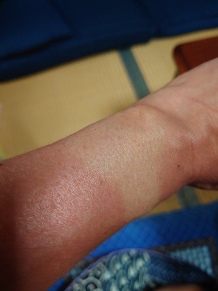 shibu_shibuo28's tweet image. ラジコン焼け(^o^)
＃DT03
#TL01