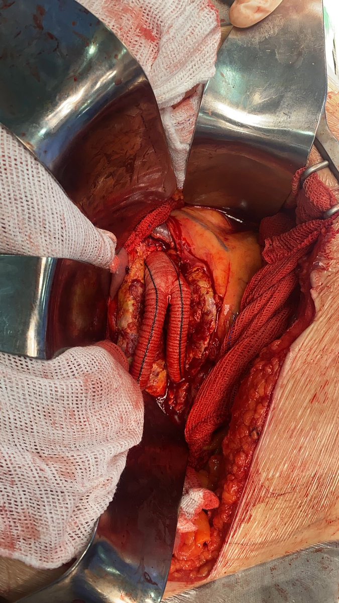 This is Clarice. She came to undergo ENDO. However, despite being an infra  case, was irregular, conical and had areas questionable for a good seal. After explaining the pros and cons of each technique, the patient said: "Dr, please  go OPEN." Photo authorized by her!
#aortaEd