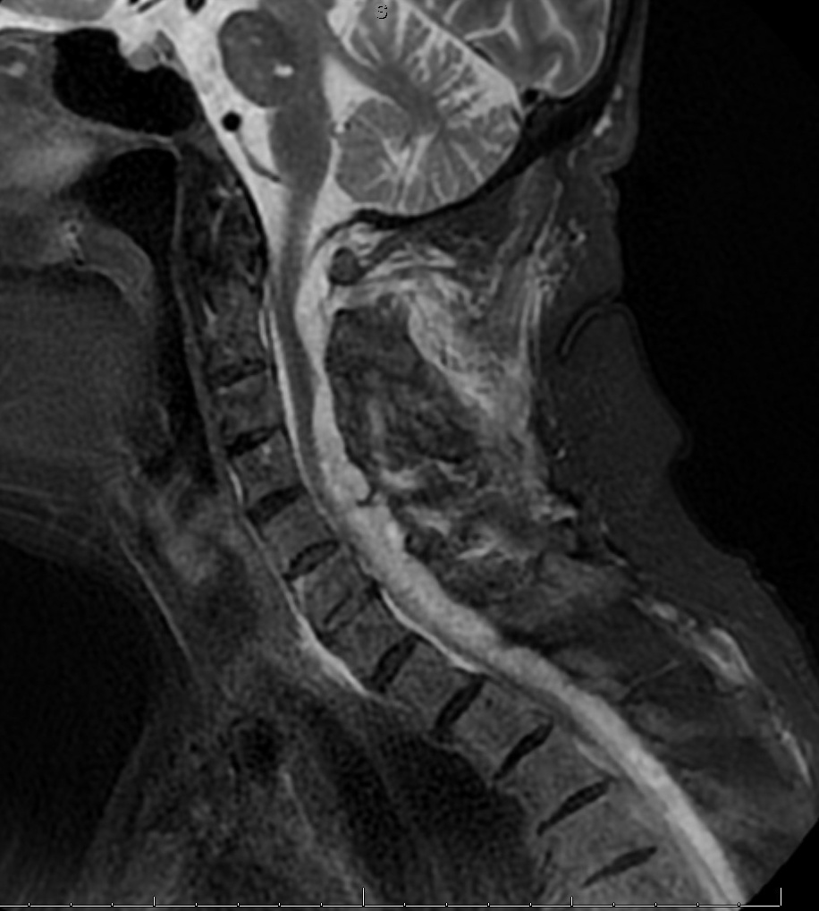 whitfieldlewis6's tweet photo. 🧵 Not Every Weakness Is a Stroke
Case: 85M s/p motor vehicle accident with acute RUE plegia & RLE weakness.
ER pushes for TNK. BP is 220/120. But something doesn’t add up…
#NeuroTwitter #StrokeMimic #SpineMRI #MedEd 
👇

 1/
She’s clutching her neck.
Writhing in pain.
Right arm pain radiates from neck to hand.
She can’t urinate.
🛑 This is not your typical stroke.

 2/
🧠 Neuro exam:

RUE: 5/5 shoulder ➝ but 1/5 wrist/finger extension
RLE: 2/5
Sensory: intact
NIHSS: 3

This is myotomal, not cortical.
 C7 distribution.

 3/
🚨 Stroke mimics matter.
The ER pushed to lower BP and give TNK.
But in cord compression, that can be devastating.
Lowering BP too aggressively can cut off spinal cord perfusion.

 4/

🧠 CT/CTA: unremarkable.
So we ordered a stat MRI C-spine.

Here’s what we found 👇
🟢 Green arrow = cord pushed left
🩸 T2 bright, T1 dark = hyperacute blood
🧠 Posterior epidural hematoma

 5/

🧾 Diagnosis:
 Hyperacute spinal epidural hematoma, post-trauma
➝ Cord compression at C6–C7

🧩 Explains:
✔️ Myotomal RUE weakness
✔️ Severe neck pain
✔️ Urinary retention
✔️ No cortical signs

 6/

🧠 Clinical pearl:

📌 Severe, focal pain
📌 Myotomal or radicular pattern
📌 Urinary retention
📌 Weakness without cortical features
🧠 Think spinal cord, not stroke
 7/
🎯 Don’t let protocol override your clinical judgment.
TNK isn’t benign — and this case proves it.
🧪 Trust your neuro exam.
You were trained to examine, not just follow flowcharts.

#NeuroTwitter #StrokeMimic #NeuroRad #ClinicalReasoning #EMConf #MedEd #NeuroBoards
 8/