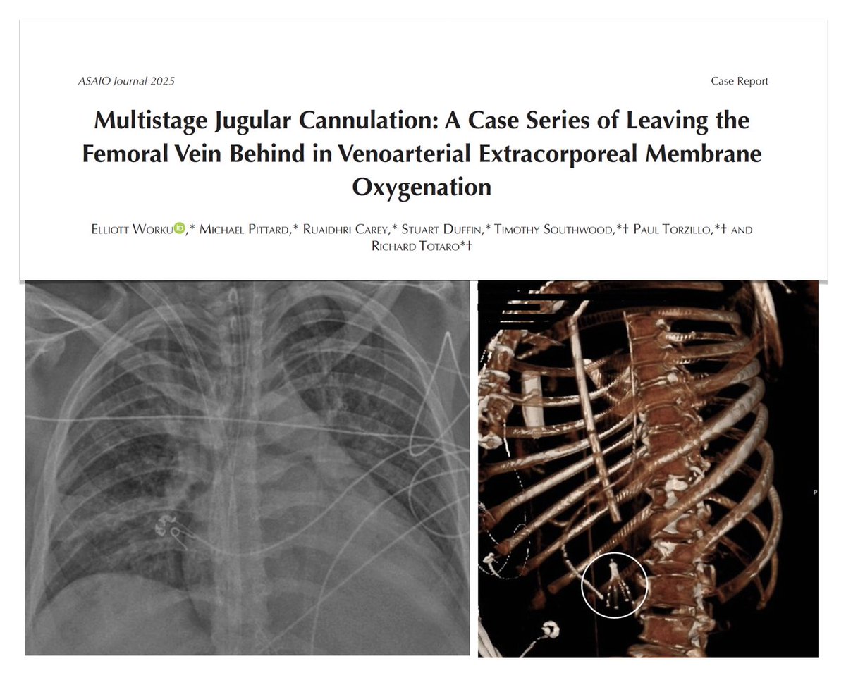 Multistage jugular cannulation: leaving femoral vein behind in VA #ECMO?? In this series, percutaneous direct SVC drainage with 38 cm drainage cannula allowed for 
🩸enhanced blood flow stability, with reduced risk for drainage insufficiency and differential oxygenation 
💪🏼