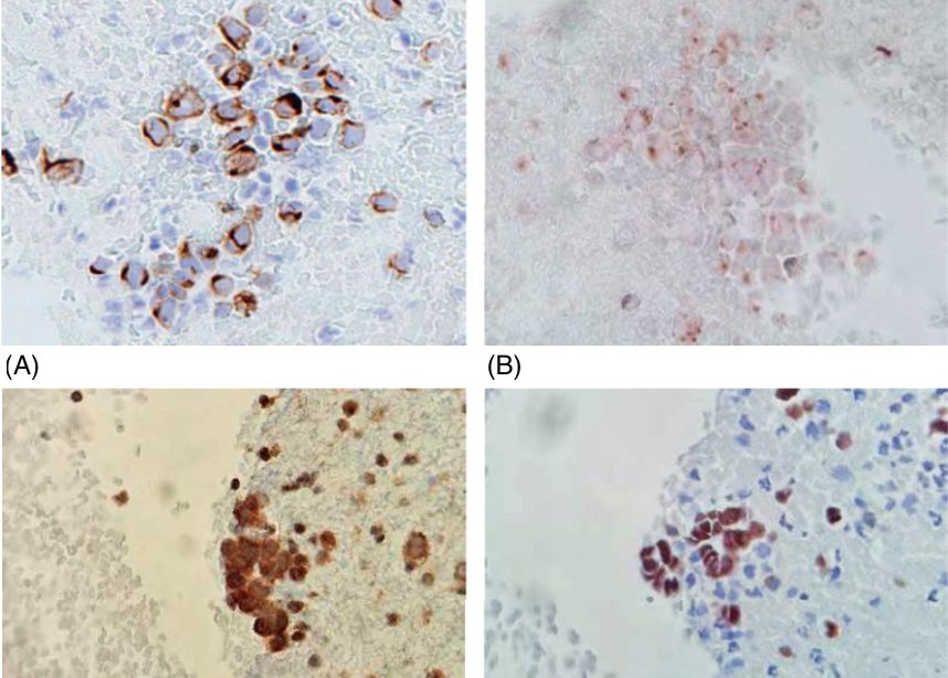 Diagnostic Cytopath (@diagnosticcyto) on Twitter photo Happy Monday! Read this brief article regarding Merkel cell carcinoma in pleural fluid cytology onlinelibrary.wiley.com/doi/epdf/10.10… by <a href="/MauroSaieg/">Mauro Saieg, MD, PhD, FIAC</a> et.al in DiCy! cc: <a href="/aakasharmand/">Zubair Baloch</a> Happy Monday! Read this brief article regarding Merkel cell carcinoma in pleural fluid cytology onlinelibrary.wiley.com/doi/epdf/10.10… by <a href="/MauroSaieg/">Mauro Saieg, MD, PhD, FIAC</a> et.al in DiCy! cc: <a href="/aakasharmand/">Zubair Baloch</a>