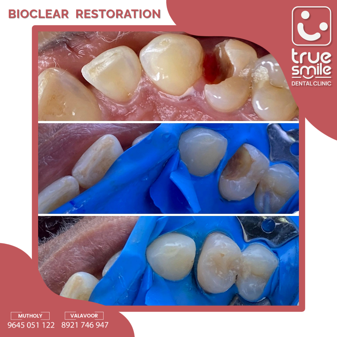 True Smile Dental Clinic (@clinictrue) on Twitter photo โจ ๐๐ข๐จ๐๐ฅ๐๐๐ซ ๐๐จ๐ฌ๐ญ๐๐ซ๐ข๐จ๐ซ ๐๐๐ฌ๐ญ๐จ๐ซ๐๐ญ๐ข๐จ๐ง
Transforming smiles with the power of the ๐๐ข๐จ๐๐ฅ๐๐๐ซ ๐๐๐ญ๐ซ๐ข๐ฑ ๐๐ฒ๐ฌ๐ญ๐๐ฆ! ๐ฆท๐ This advanced technique ensures a ๐ฌ๐๐๐ฆ๐ฅ๐๐ฌ๐ฌ, ๐๐ฎ๐ซ๐๐๐ฅ๐, ๐๐ง๐ ๐ง๐๐ญ๐ฎ๐ซ๐๐ฅ-๐ฅ๐จ๐จ๐ค๐ข๐ง๐ restoration, giving โจ ๐๐ข๐จ๐๐ฅ๐๐๐ซ ๐๐จ๐ฌ๐ญ๐๐ซ๐ข๐จ๐ซ ๐๐๐ฌ๐ญ๐จ๐ซ๐๐ญ๐ข๐จ๐ง
Transforming smiles with the power of the ๐๐ข๐จ๐๐ฅ๐๐๐ซ ๐๐๐ญ๐ซ๐ข๐ฑ ๐๐ฒ๐ฌ๐ญ๐๐ฆ! ๐ฆท๐ This advanced technique ensures a ๐ฌ๐๐๐ฆ๐ฅ๐๐ฌ๐ฌ, ๐๐ฎ๐ซ๐๐๐ฅ๐, ๐๐ง๐ ๐ง๐๐ญ๐ฎ๐ซ๐๐ฅ-๐ฅ๐จ๐จ๐ค๐ข๐ง๐ restoration, giving