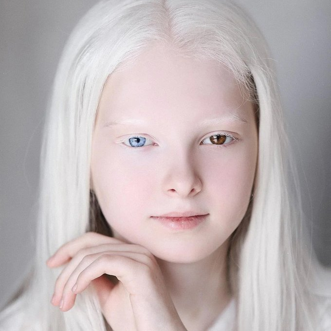 Personas con el color de piel más inusual.

Lo que vas a ver te sorprenderá.

Un hilo🧵