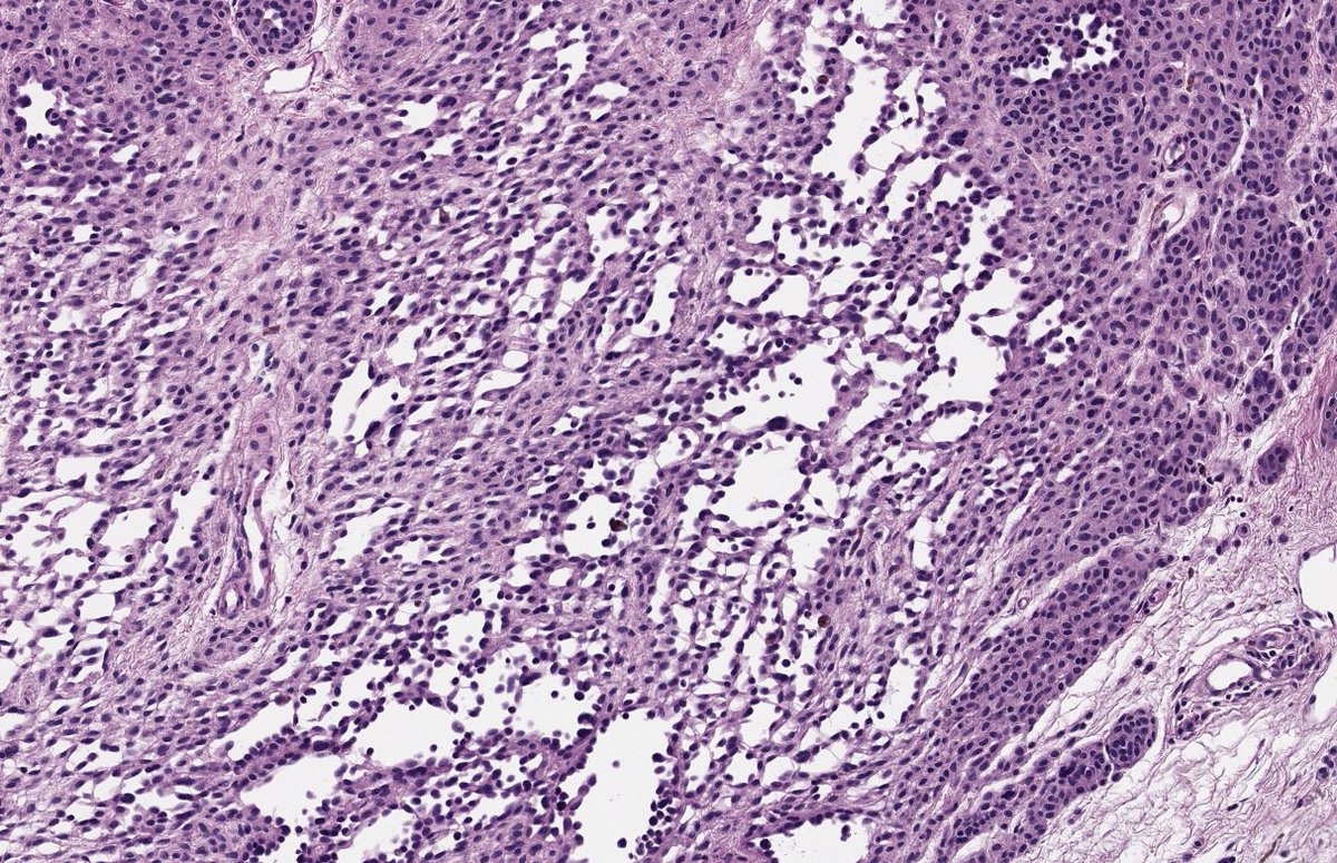 Classic pseudovascular spaces in a benign nevus. 
#dermpath #PathTwitter  #dermtwitter