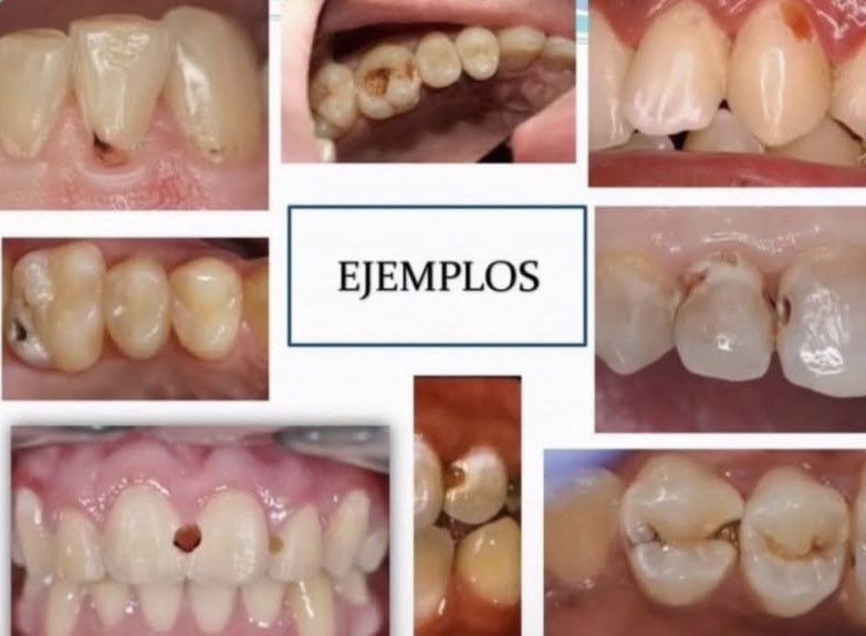 necesito pacientes 🙏🏽 si tenes una caries como en la fotoo, sin dolor hablame 3624025955