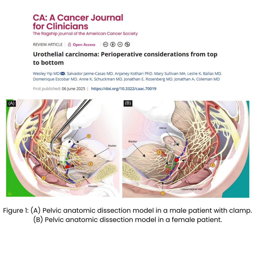 CA: A Cancer Journal for Clinicians (@cacancerjournal) on Twitter photo New review on urothelial carcinoma highlights therapeutic & diagnostic approaches in the perioperative setting, emphasizing patient‐centered & individualized care. acsjournals.onlinelibrary.wiley.com/doi/full/10.33… <a href="/WesleyYipMD/">Wesley Yip</a> <a href="/SalvadorjcMD/">Salvador Jaime-Casas, MD</a> <a href="/KothariAnjaney/">Anjaney Kothari</a> <a href="/domesypantsx3/">Domenique Escobar, MD 👩🏽⚕️🧜🏽♀️</a> <a href="/AnneSchuckmanMD/">Anne Schuckman</a> <a href="/DrRosenbergMSK/">Jonathan Rosenberg MD</a> New review on urothelial carcinoma highlights therapeutic & diagnostic approaches in the perioperative setting, emphasizing patient‐centered & individualized care. acsjournals.onlinelibrary.wiley.com/doi/full/10.33… <a href="/WesleyYipMD/">Wesley Yip</a> <a href="/SalvadorjcMD/">Salvador Jaime-Casas, MD</a> <a href="/KothariAnjaney/">Anjaney Kothari</a> <a href="/domesypantsx3/">Domenique Escobar, MD 👩🏽⚕️🧜🏽♀️</a> <a href="/AnneSchuckmanMD/">Anne Schuckman</a> <a href="/DrRosenbergMSK/">Jonathan Rosenberg MD</a>
