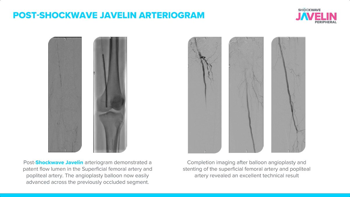 ShockwaveIVL's tweet image. In a 75-year-old female with occluded SFA-POP arteries, Dr. Paul Foley used #ShockwaveJavelin to crack and cross the calcium and create a flow lumen. Then, Dr. Foley was able to deliver angioplasty balloons and stents to increase perfusion to the patient’s heel, which was…