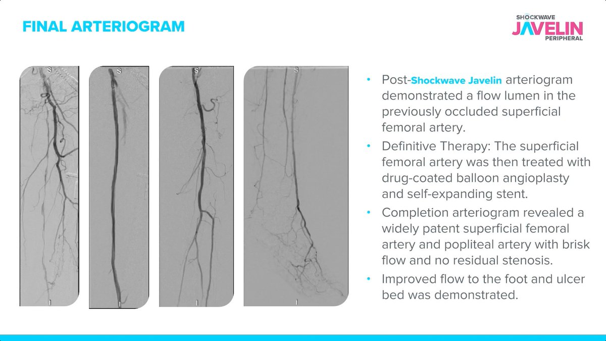 ShockwaveIVL's tweet image. While treating a 68-year-old female with an occluded SFA, Dr. Paul Foley could only get a short segment of 0.014 wire into the proximal cap of the SFA — and a crossing catheter would not advance through the CTO. Dr. Foley used #ShockwaveJavelin to successfully cross the cap and…