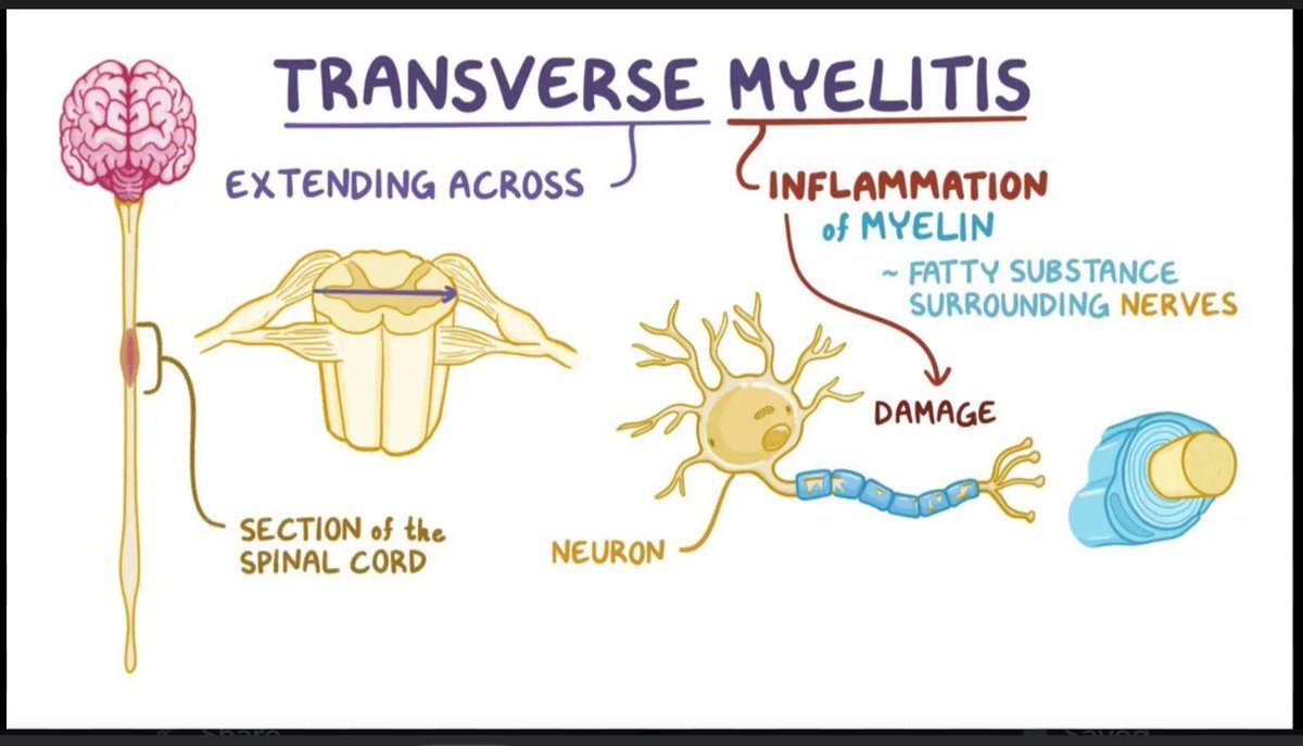 PlymUnit's tweet image. #TransverseMyelitis awareness day! Please help raise awareness of this rare condition that can be life changing to some. #raisingawareness #spinalinjury