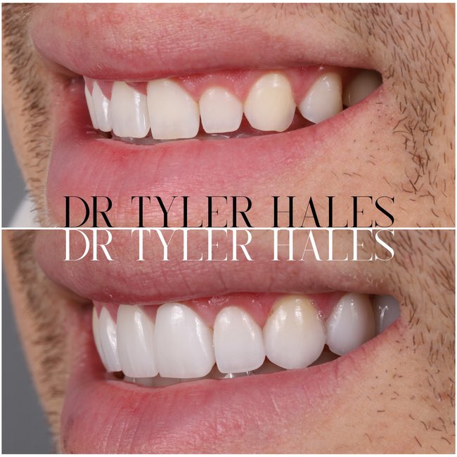 Luxury is in the details ✨especially in your smile! Each veneer is crafted to flatter your natural smile, brighten your features and last for years. This case was done with no preparation to the teeth, no needles and no pain. No Prep Harmony Veneers are changing dentistry.