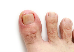 SoCalFootAnkle's tweet image. Tired of recurring ingrown nails? We provide long-term solutions to keep them from coming back. 🏃‍♂️ #IngrownNailTreatment #HealthyFeet
bit.ly/3AYdm79