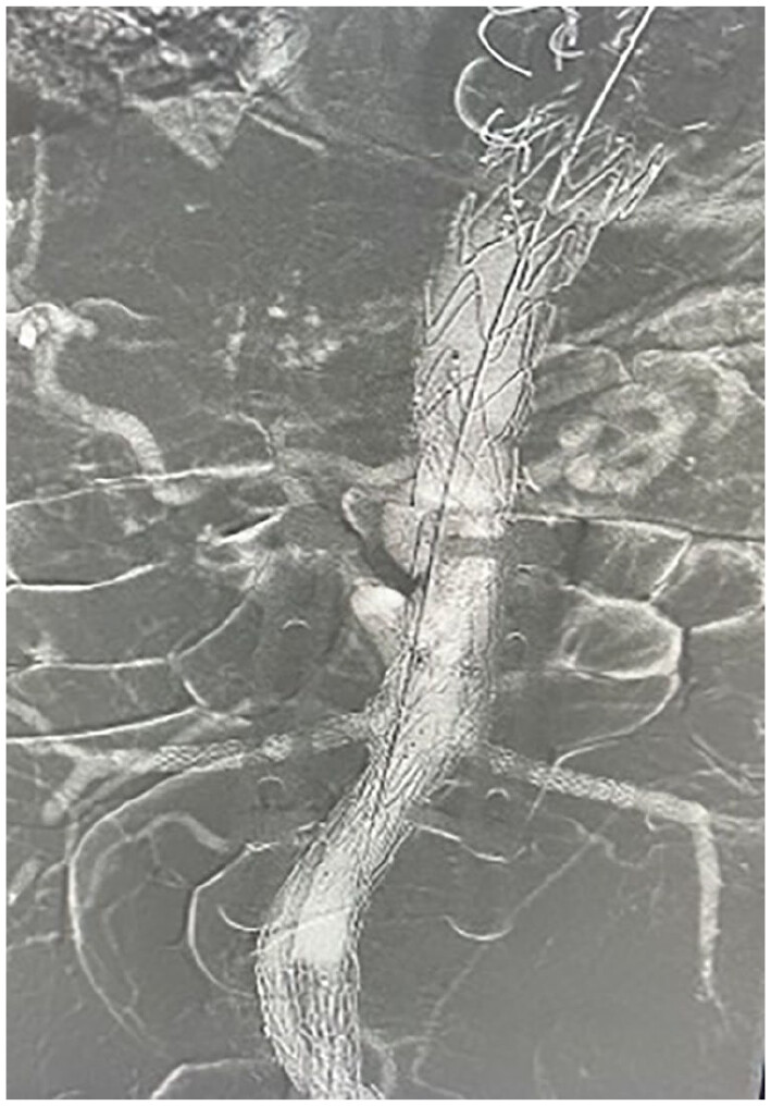 Endovascular Therapy (@jendovasculart) on Twitter photo This contrast-free protocol using carbon dioxide angiography for fenestrated/branched endovascular aneurysm repair can reduce the risk of renal damage, facilitating access to F/BEVAR for patients with chronic kidney disease journals.sagepub.com/doi/10.1177/15… This contrast-free protocol using carbon dioxide angiography for fenestrated/branched endovascular aneurysm repair can reduce the risk of renal damage, facilitating access to F/BEVAR for patients with chronic kidney disease journals.sagepub.com/doi/10.1177/15…