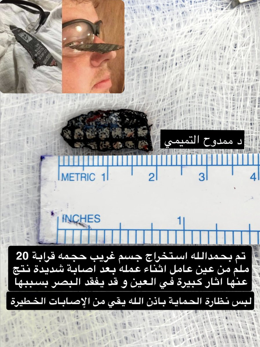 تم بحمدالله استخراج جسم كبير الحجم 20 ملم تقريبا من عين عامل أثناء عمله 
بعد تعرضه لاصابة شديدة بالعين 
و قد يفقد البصر بسببها 
ليس نظارة الحماية باذن الله يقي من الإصابات الخطيرة للعين و الله خير حافظ