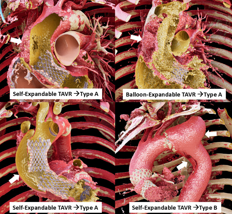 viewtify's tweet photo. The first paper using Viewtify from outside Japan is now published!
Dr. Fukuhara’s team at the University of Michigan visualized a TAVR-related aortic dissection in 3D using Viewtify.
Open access—check it out!
https://t.co/Hm1bmm3WBl https://t.co/2eG9Td0Z9o