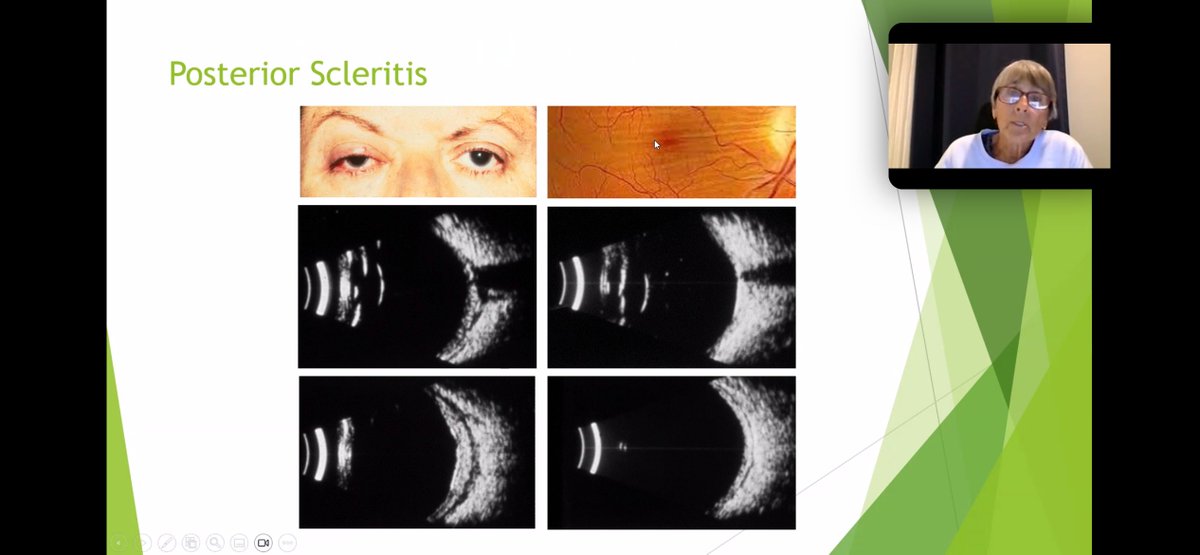 USSONAR_Rh's tweet image. Ultrasound use in rheumatology extends beyond MSK. Cathy DiBernardo and Dr. Quan Dong Nguyen reviews expert use of ultrasound in ocular disorders seen in SLE and other rheumatic disease
#Lupus2025 #POCUS #Ophthalmology #Ultrasound #CME #Meded