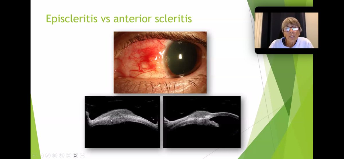 USSONAR_Rh's tweet image. Ultrasound use in rheumatology extends beyond MSK. Cathy DiBernardo and Dr. Quan Dong Nguyen reviews expert use of ultrasound in ocular disorders seen in SLE and other rheumatic disease
#Lupus2025 #POCUS #Ophthalmology #Ultrasound #CME #Meded