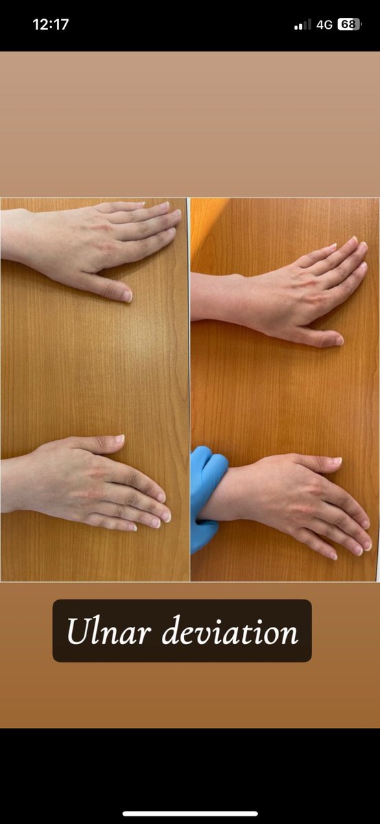 Afrah11209's tweet photo. This is my brave patient who overcome her functional limitations due to stiffness in both wrist after 1month she’s highly improved as  following:

RT HAND:
Extension=35 +5
Flexion=30 
RD= 15 +5 (full)
UD=30 +10 (full)

LT HAND:
Extension=35 +10
flexion=45
RD=10 
UD=20 +5 https://t.co/vOiVeWqsbp