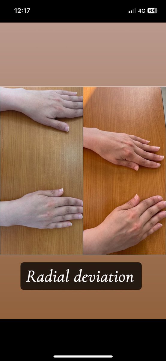 Afrah11209's tweet photo. This is my brave patient who overcome her functional limitations due to stiffness in both wrist after 1month she’s highly improved as  following:

RT HAND:
Extension=35 +5
Flexion=30 
RD= 15 +5 (full)
UD=30 +10 (full)

LT HAND:
Extension=35 +10
flexion=45
RD=10 
UD=20 +5 https://t.co/vOiVeWqsbp