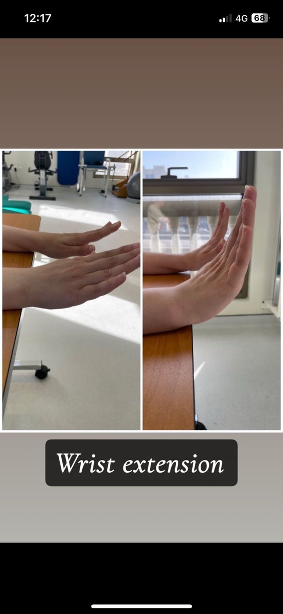 Afrah11209's tweet photo. This is my brave patient who overcome her functional limitations due to stiffness in both wrist after 1month she’s highly improved as  following:

RT HAND:
Extension=35 +5
Flexion=30 
RD= 15 +5 (full)
UD=30 +10 (full)

LT HAND:
Extension=35 +10
flexion=45
RD=10 
UD=20 +5 https://t.co/vOiVeWqsbp