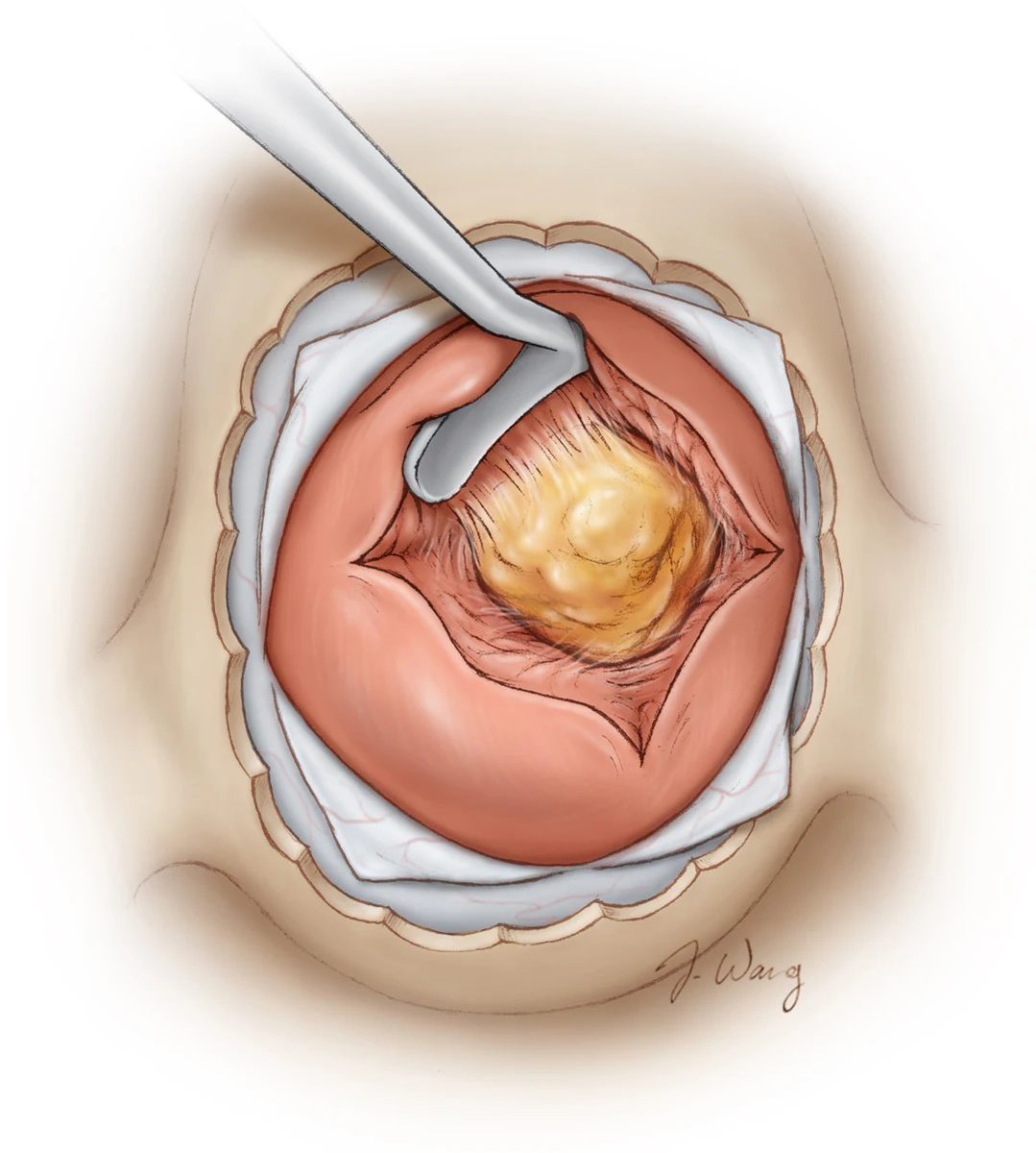 Due to its small size and central location, pituitary microadenomas may be difficult to see. In the case that the tumor is not originally visible, what tool should be used (and in what direction) to get the tumor within the surgical field? 

#Neurosurgery #EndoscopicSurgery
