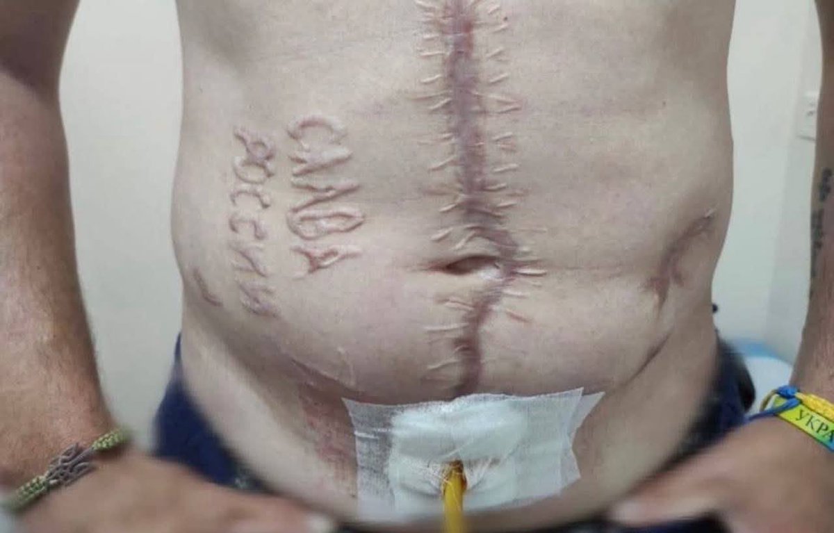 MelnykAndrij's tweet image. All you need to know about Russia. A Ukrainian prisoner of war, recently liberated from Russian captivity, has revealed horrific signs of torture.
Russian butchers carved the words “СЛАВА РОССИИ” (“Glory to Russia”) into his skin. It’s time to stop this madness🤬🤬🤬