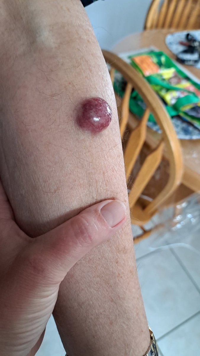 InkedDeviant's tweet photo. I Swear It. 
My Pops Is Fighting Merkel Cell Carcinoma And It's Aggressive As Hell -  It's Not Curable. He Also Has Dementia. 

He's Had x4 Covid 💉's I Begged Him To Stop. 

Anyone Who Knows Me Well KNOWS I'm A Dads Girl. 

This Is Killing Me. Slowly. 
#InkedOut https://t.co/47pr7OPYjK