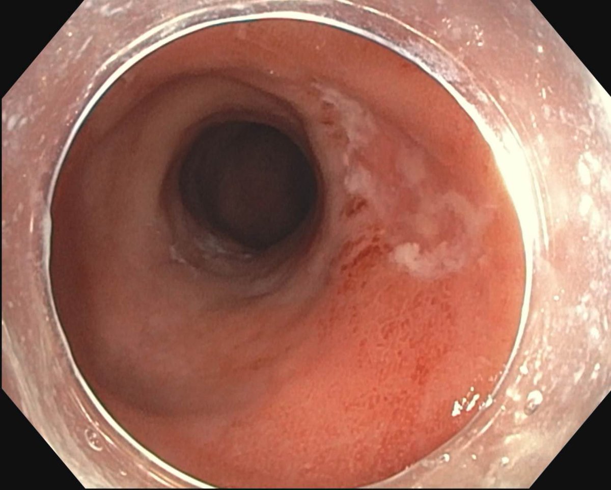 #MondayNightIBD tweet media