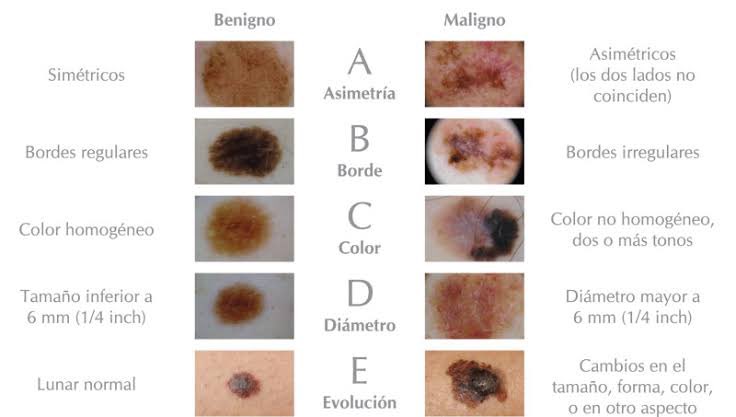 Med4Dummiess_'s tweet image. MELANOMA 🚨

1️⃣ Representa 1–2% de los cánceres de piel, pero es el + letal
2️⃣ Incidencia en aumento globalmente
3️⃣ Edad promedio: 50–60 años
4️⃣ Factores: piel clara, radiación UV, quemaduras solares en infancia
5️⃣ + frecuente en espalda (hombres) y piernas (mujeres)