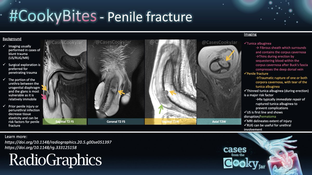 Answer: Penile Fracture

Learn more: doi.org/10.1148/radiog…
doi.org/10.1148/rg.333…

#CookyBites #217 #RGphx <a href="/cookyscan1/">Cooky Menias</a> <a href="/RadioGraphics/">RadioGraphics</a>