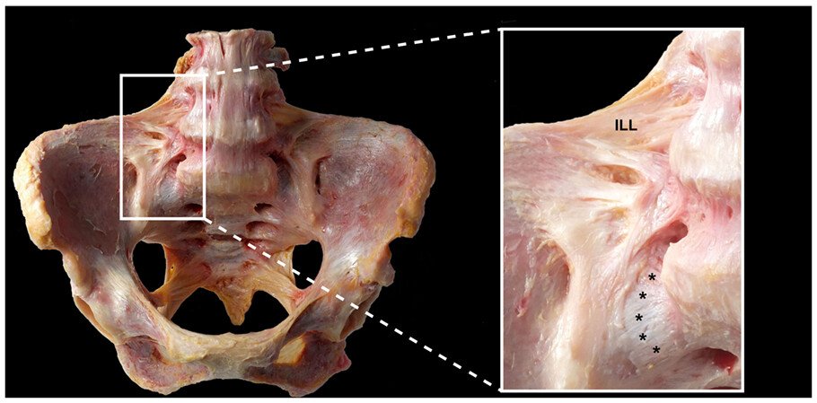 DavidMackeyDPT's tweet photo. SIJ motion? Barely there. This study supports that SIJ is built for stability, not big movements. Under physiological loads, the lumbosacral junction does the heavy lifting. Is our field overdiagnosing &amp; overtreating SIJ dysfunction?
https://t.co/4ON87jUCjK https://t.co/lU1bBRGZI1