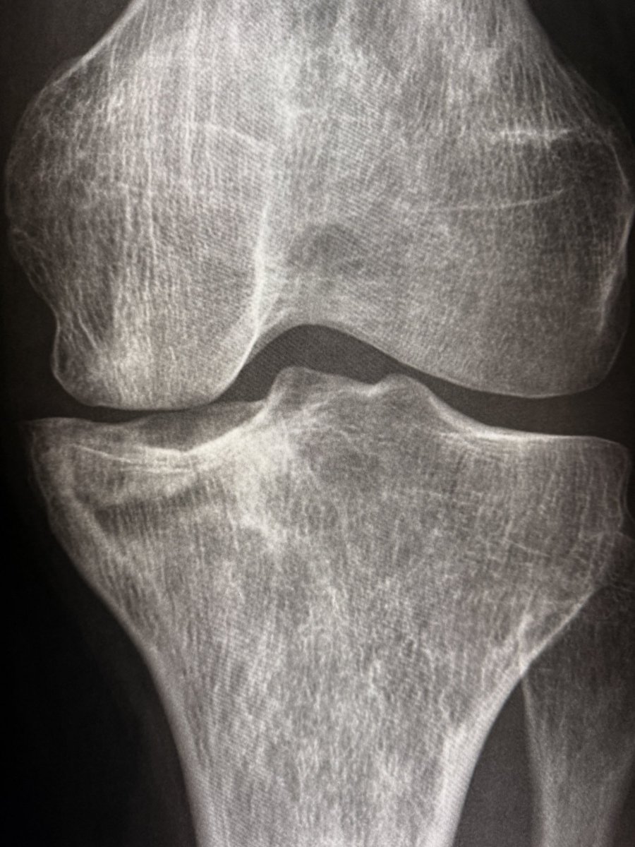 In sickle cell disease, chronic bone infarcts appear as intramedullary serpiginous sclerosis in the metadiaphyseal region with 
coarse, sclerotic trabecular pattern. Cortical thickening with “bone within bone” appearance. 

+ AVN of distal femoral &amp; proximal tibial condyles

+