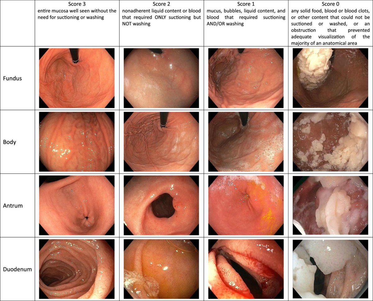 The Toronto Upper GI Cleaning Score (TUGCS)