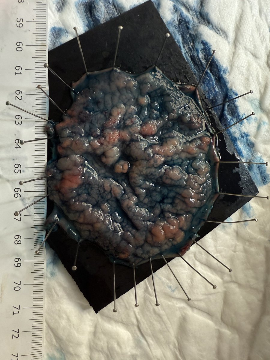 En 48 horas comienza el curso de endoscopia de tercer espacio malaga live!, si quieres ver y aprender a quitar cosas como estas de ayer… ya sabes

institutoendoscopiaavanzada.com
