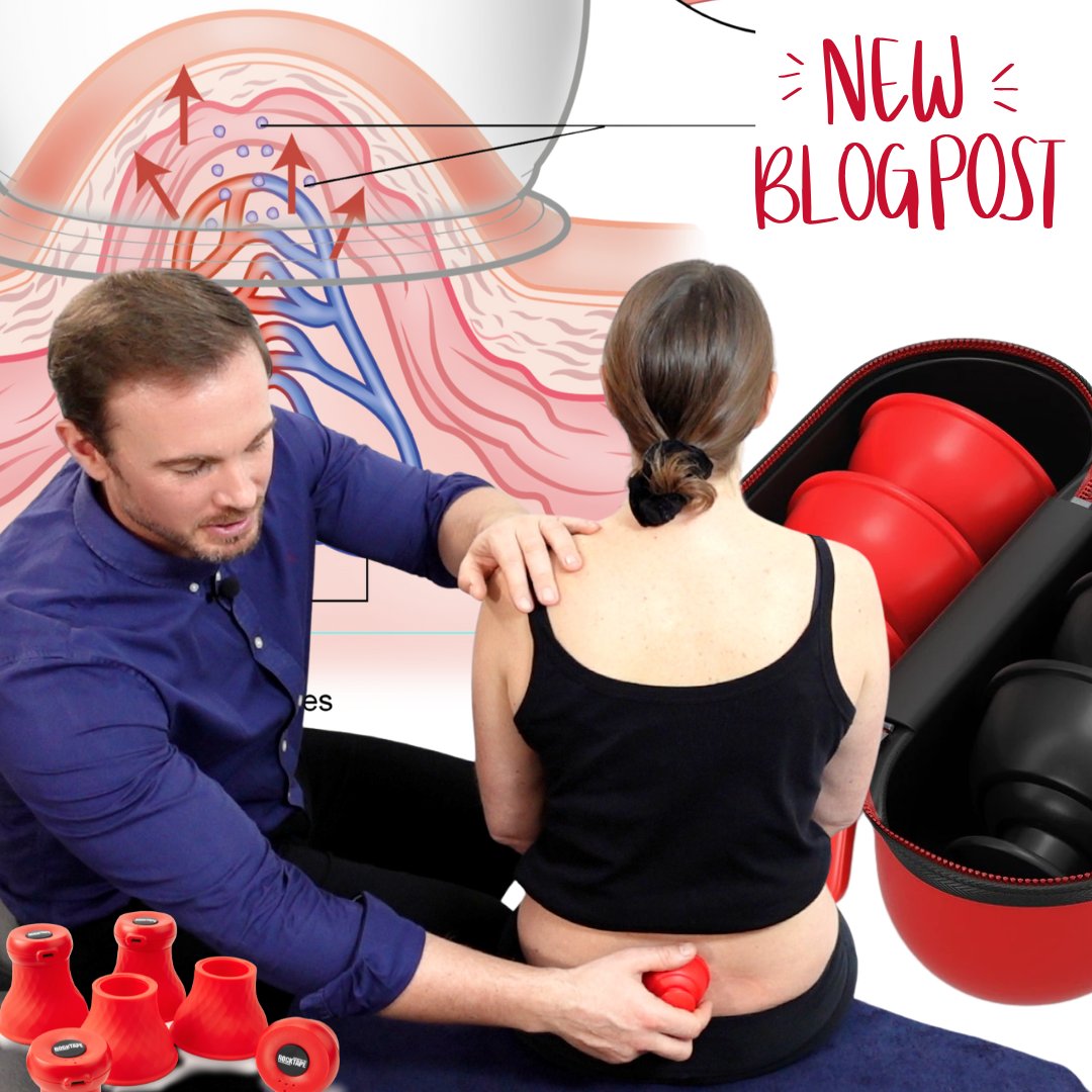 Cupping therapy for #LowBackPain? 

A big review of studies says YES! 

It significantly improves pain &amp; disability, often outperforming meds and usual care in the short-term.