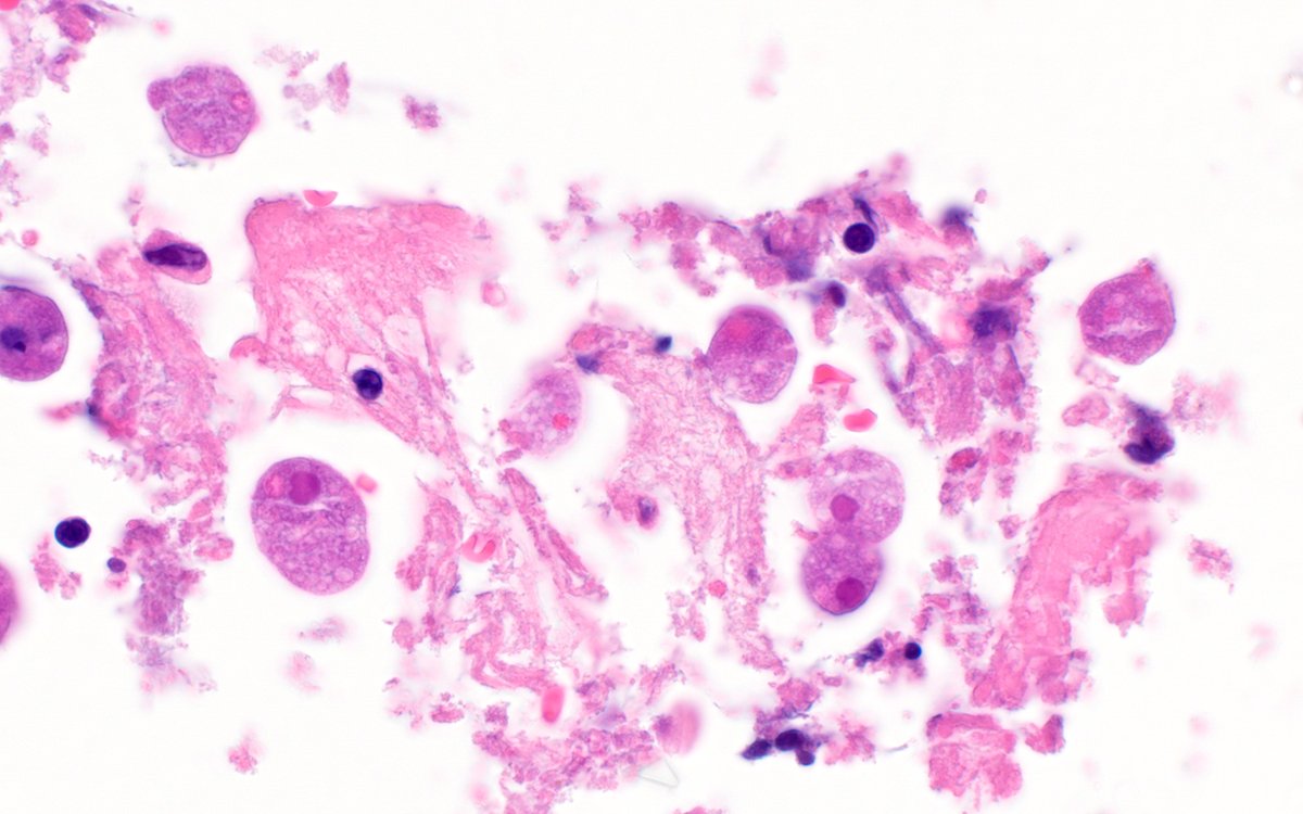 ParasiteGal's tweet photo. The #Parasite case 778 is now up: https://t.co/eSkqAsYPev - colon biopsy from a patient with abdominal pain and diarrhea. Objects seen are 20 microns. What is your diagnosis?
Answer later this week!
#mayopath #pathology #PathBugs https://t.co/t2Mm26SRRD