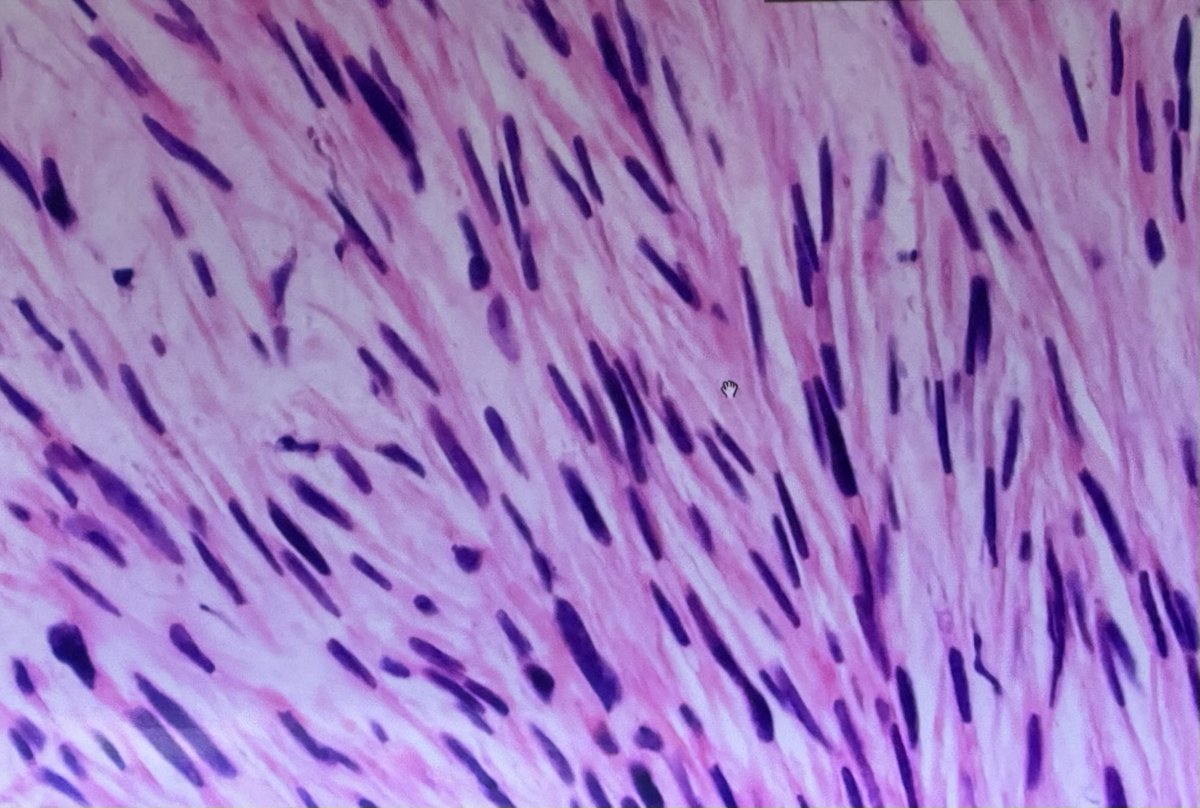 Successfully identified spindle cells at tumor board and this must have been how Neo felt when he could see the Matrix
