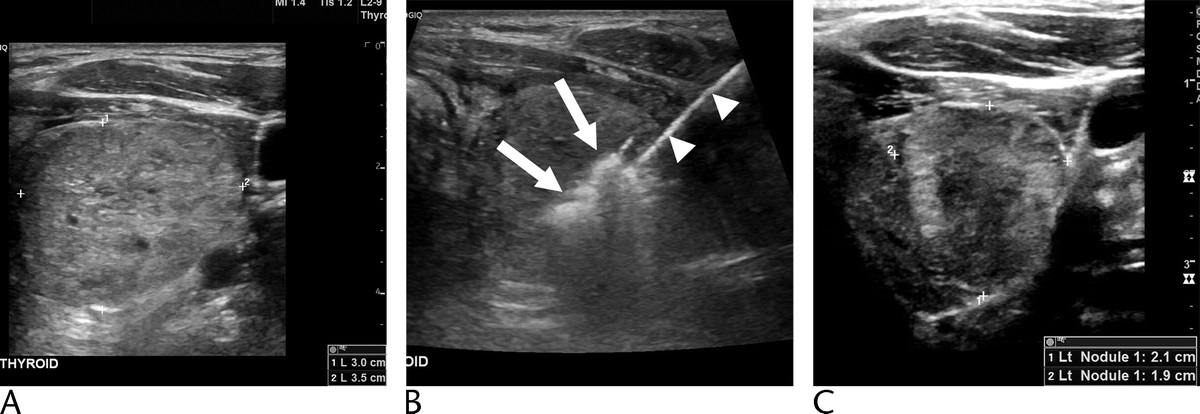 Quantification of Initial Symptom Relief Following Ultrasound-Guided Radiofrequency Ablation of Benign Thyroid Nodules dlvr.it/TLGdyd