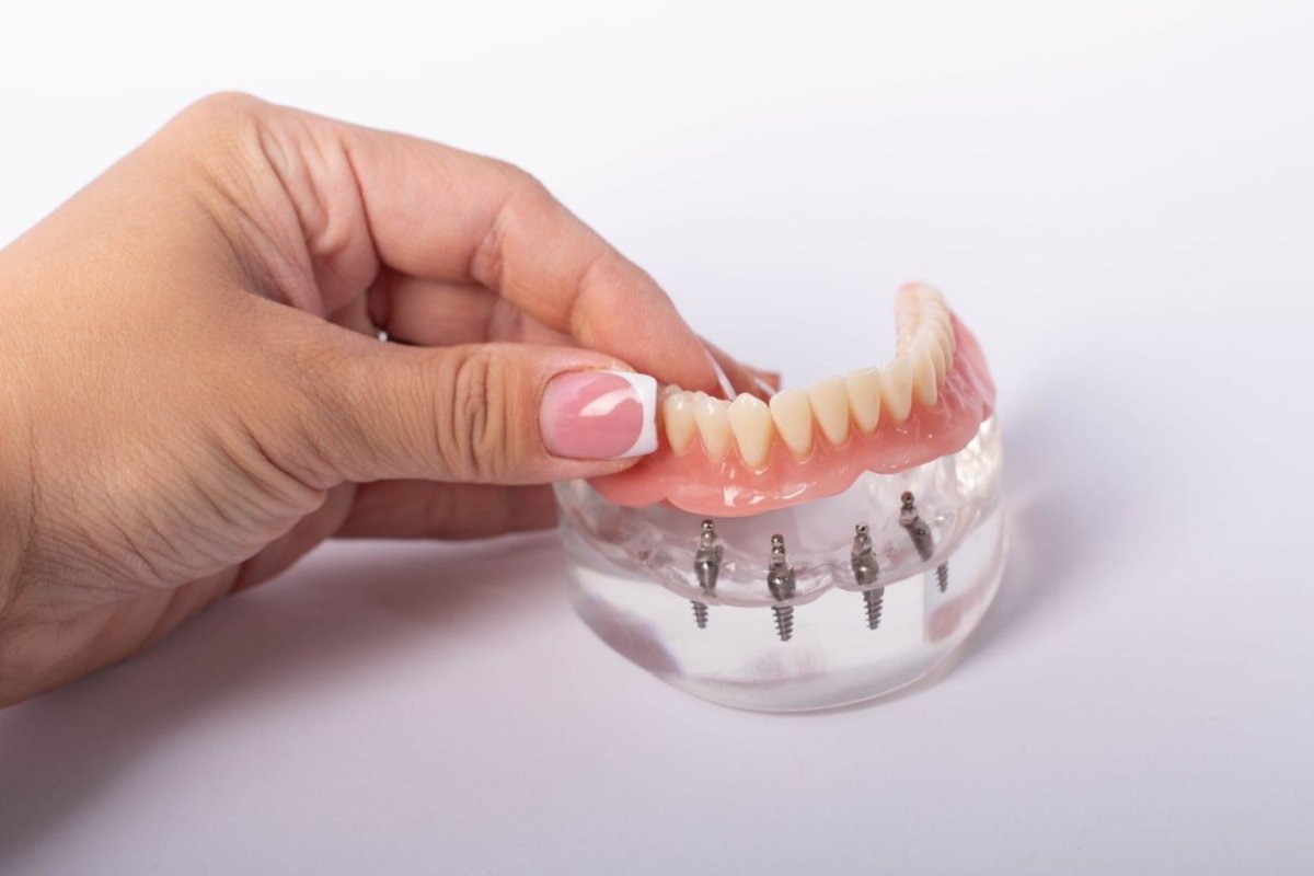 Missing teeth? Mountain Periodontics offers advanced solutions like All-On-4® and Teeth-in-a-Day to restore your smile’s function and beauty. Expert care, lasting results. Book your consultation today!

#MountainPeriodontics #DentalImplants #AllOn4 #TeethInADay #ImplantDentistry