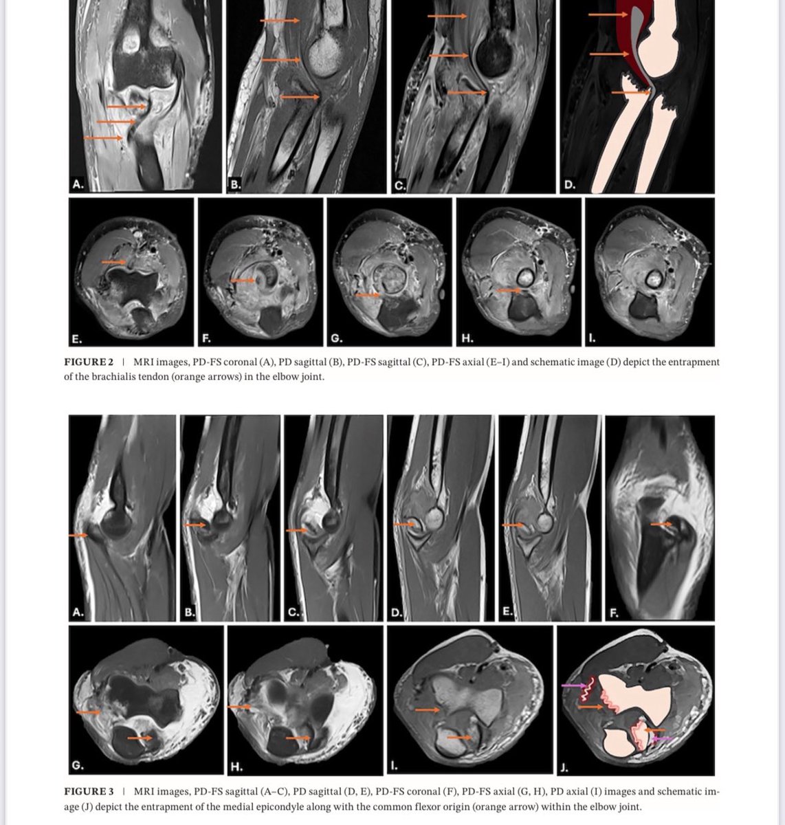 mskradiology4u (@mskradiology4u1) on Twitter photo My 397th publications
Latest paper in colloboration with <a href="/kartikp31/">K P Iyengar</a> , ankit shah, ankur shah, Chinmay Mehta, praveen chinniah and Kapil Shirodkar onlinelibrary.wiley.com/doi/10.1111/17… <a href="/MSKSocietyIndia/">MSS India</a> <a href="/ESSRmsk/">European Society of Musculoskeletal Radiology</a> <a href="/intskeletal/">International Skeletal Society | ISS</a> <a href="/ROHNHSFT/">The Royal Orthopaedic Hospital</a> <a href="/ROHImaging/">ROHImaging</a> <a href="/BSSR_Site/">BSSR</a> My 397th publications
Latest paper in colloboration with <a href="/kartikp31/">K P Iyengar</a> , ankit shah, ankur shah, Chinmay Mehta, praveen chinniah and Kapil Shirodkar onlinelibrary.wiley.com/doi/10.1111/17… <a href="/MSKSocietyIndia/">MSS India</a> <a href="/ESSRmsk/">European Society of Musculoskeletal Radiology</a> <a href="/intskeletal/">International Skeletal Society | ISS</a> <a href="/ROHNHSFT/">The Royal Orthopaedic Hospital</a> <a href="/ROHImaging/">ROHImaging</a> <a href="/BSSR_Site/">BSSR</a>