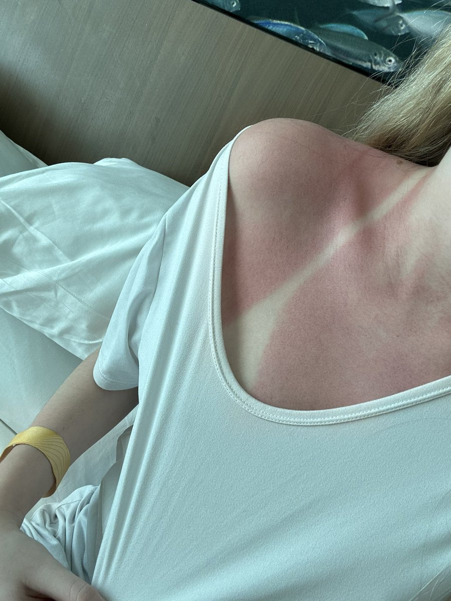 DO NOT USE CARROTEN IF YOU DONT ALREADY HAVE GOOD TANNING GENES